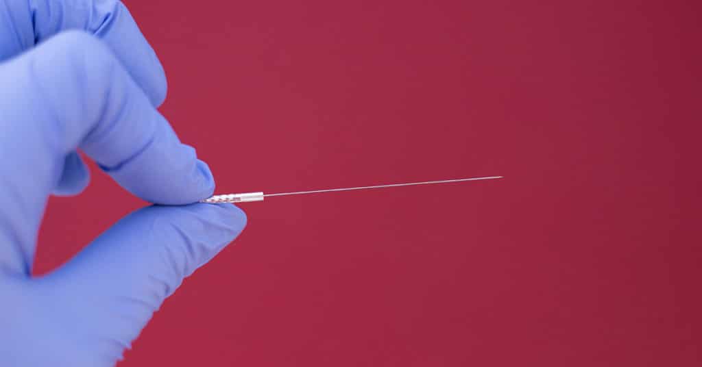Dry needling Tartu