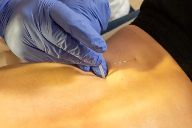 Dry needling